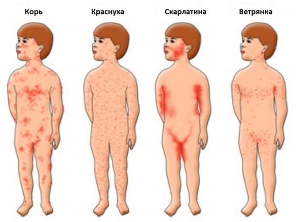 КРАТКИЙ ПУТЕВОДИТЕЛЬ ПО ДЕТСКИМ БОЛЕЗНЯМ. КАК ВЫГЛЯДИТ СЫПЬ ПРИ РАЗНЫХ ЗАБОЛЕВАНИЯХ.